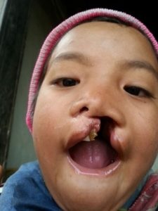 MEND patient - cleft palate in Kashmir
